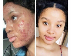 HT26 Paris Preparation Anti Blemish Maximal Bleaching Activating Serum 50ml / 1.7oz