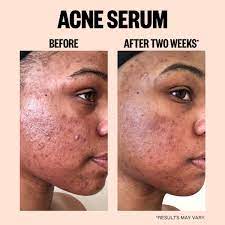 Caro white light drop hyperpigmentation serum Carowhite