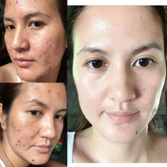 Acne gone medicated healer 4oz acne gone