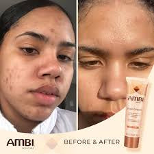 Ambi Fade Cream Oily Skin 2 oz AMBI